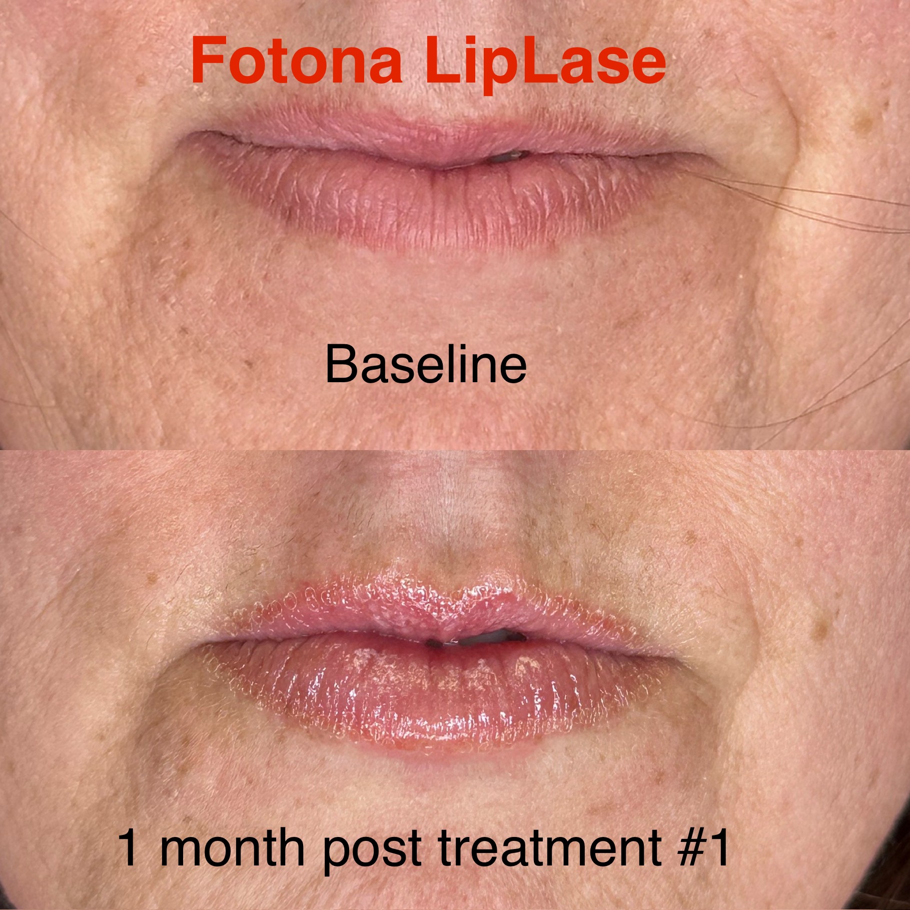 Before and after LipLase treatment