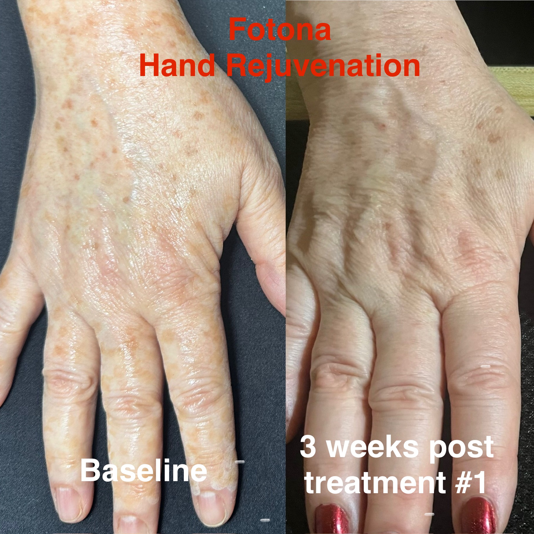Before and After Hand Rejuvenation
