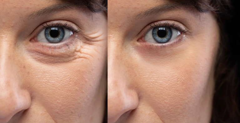 Before After Wrinkle Relaxers and Fillers