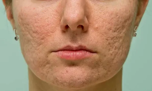 Adult Acne Scars